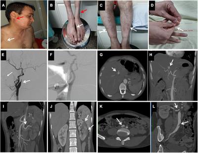 Case report: Characterization of a rare pathogenic variant associated with loss of COL3A1 expression in vascular Ehlers Danlos syndrome